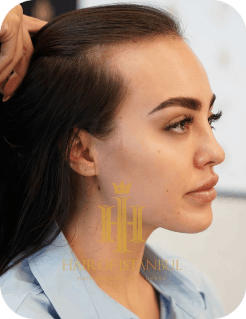 Top 48 image hair transplant for women 