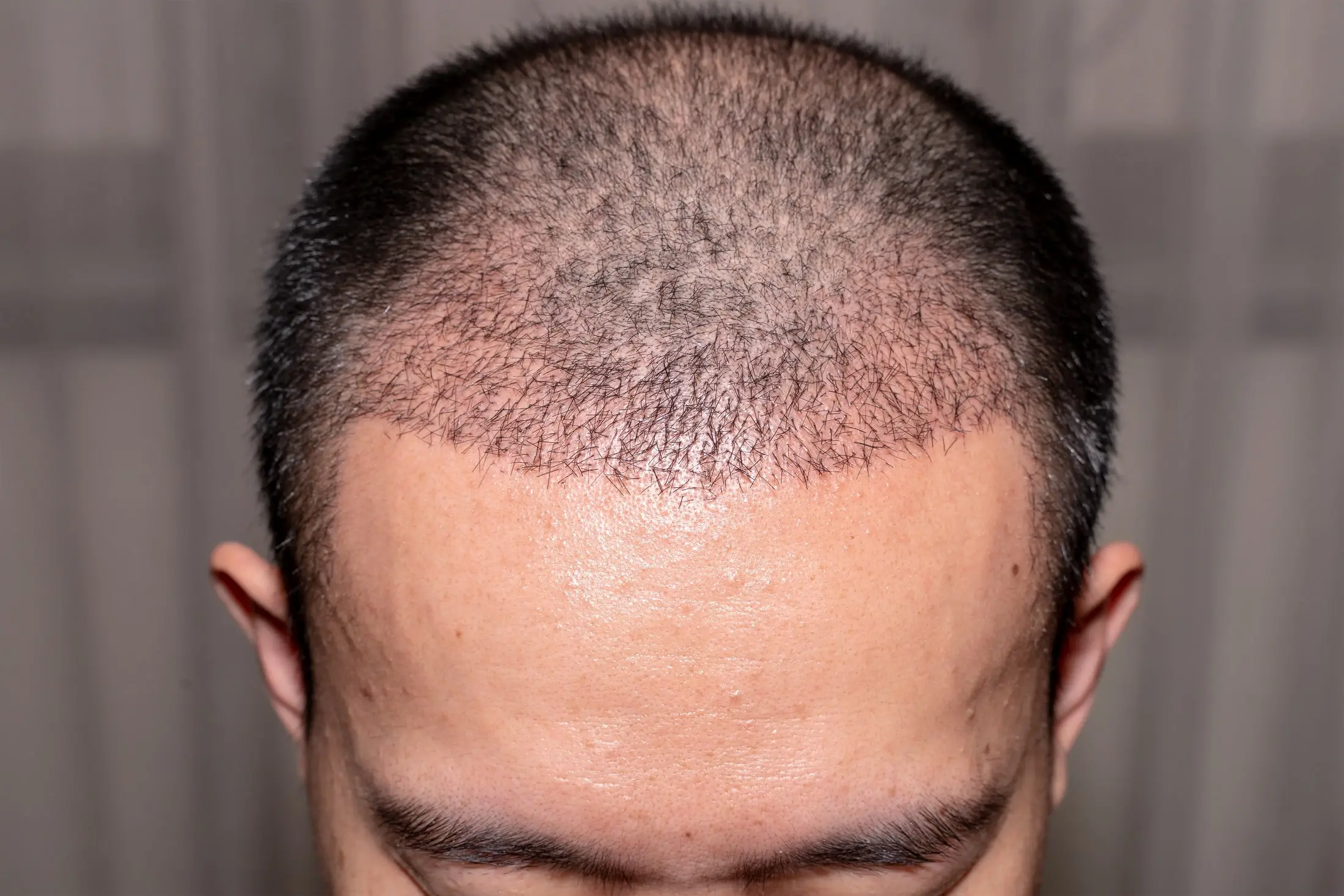 Is a Hair Transplant Permanent? | Hair of Istanbul