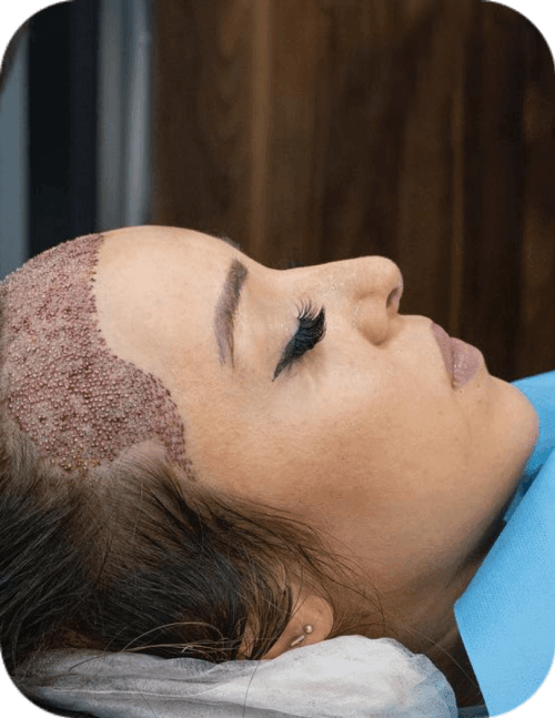 after woman hair transplant